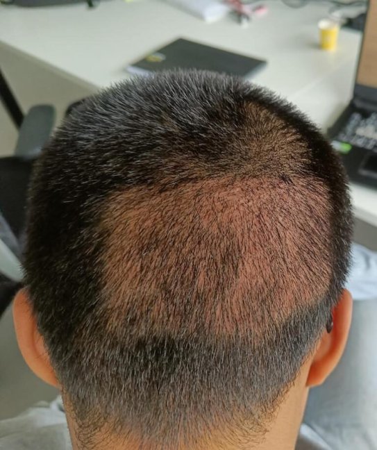 saç ekiminde aşırı toplama