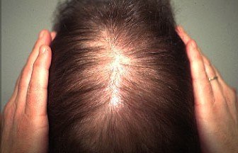 kadınlarda saç dökülmesi