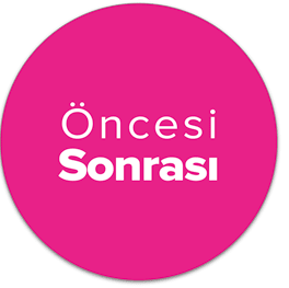 saç-ekimi-öncesi-sonrası