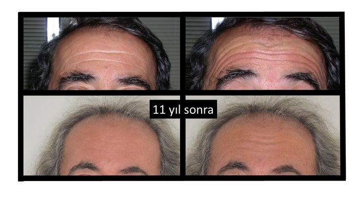 uzun süreli botoks etkisi - 5