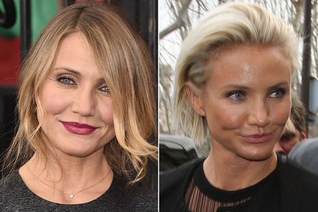 botoks yaptıran ünlü - 8