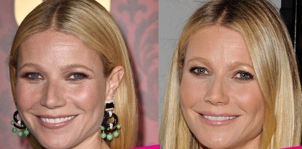 botoks yaptıran ünlü - 10