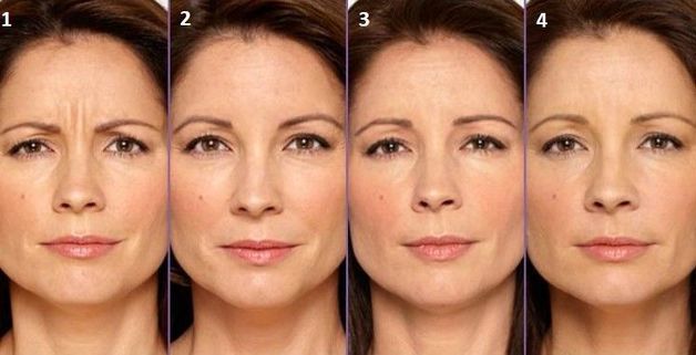 botoks etkisi nasıl biter -11