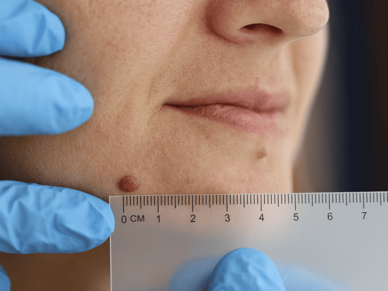 Can a mole return after it is removed?