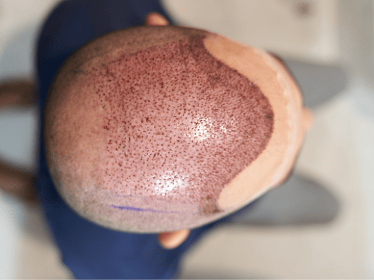 How many hair transplant grafts for a full head?