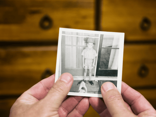 Hair Transplantation and Genetics