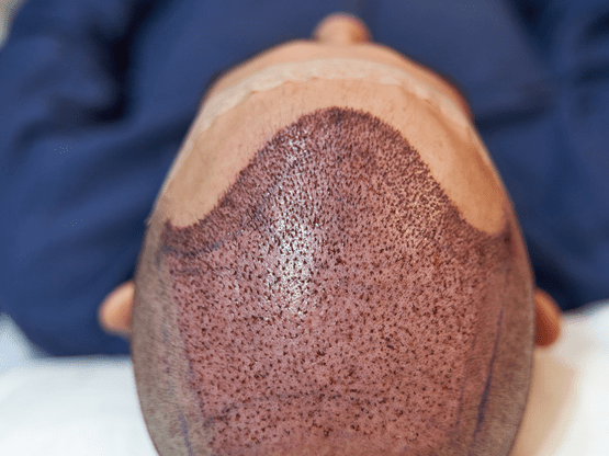 3,000+ DHI Hair Transplants: 10 Things You Must Know