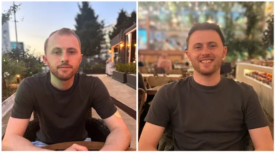 Patient Interview: James’s Hair Transplant Review in Turkey at DK Klinik