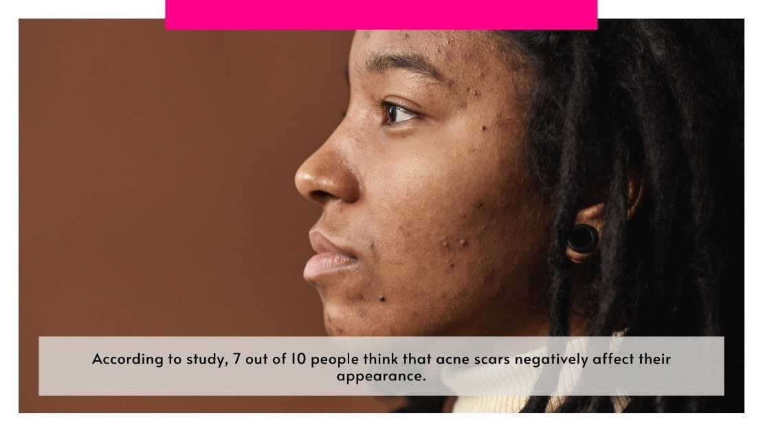 acne scars