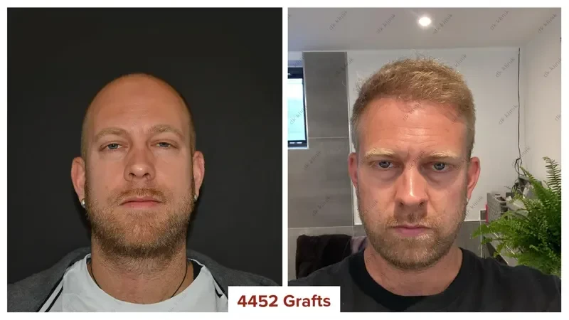 Hair-Transplant-Turkey-Antalya-Before-After-4400-Grafts