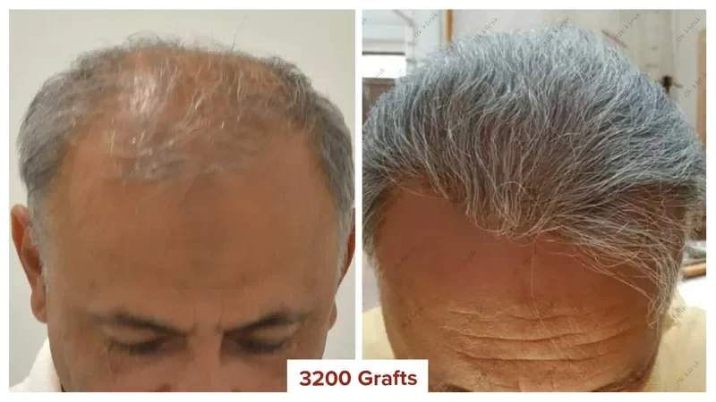 Hair-Transplant-Turkey-Before-After-3200-Grafts-4