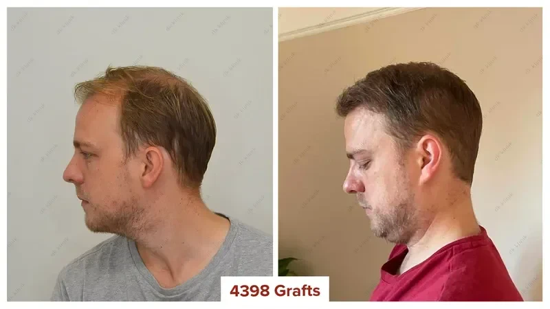 Hair-Transplant-Turkey-Before-After-4400-Grafts