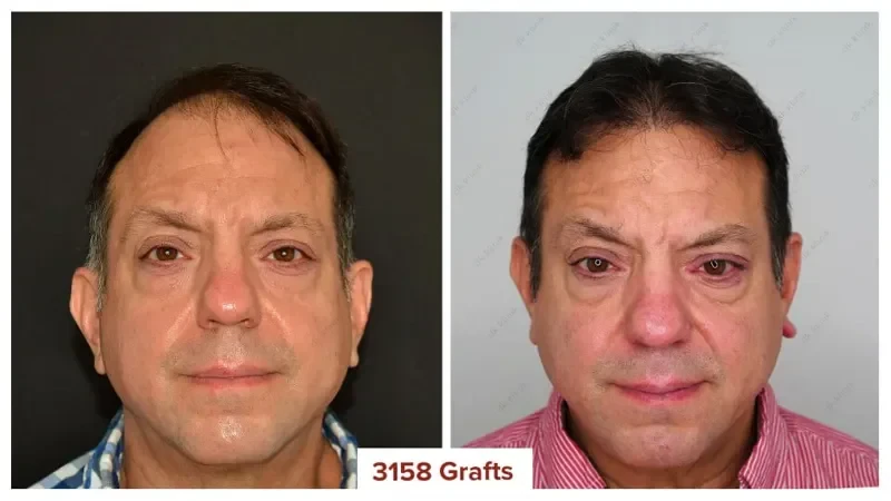 Hair-Transplant-Turkey-Before-After-3100-Grafts-4
