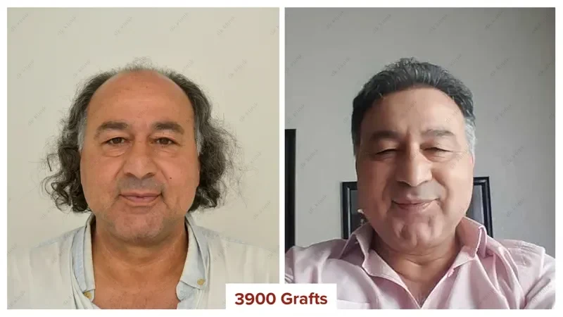 Hair-Transplant-Turkey-Before-After-3900-Grafts