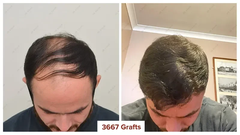 Hair-Transplant-Turkey-Before-After-3700-Grafts