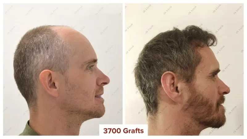 Hair-Transplant-Turkey-Before-After-3700-Grafts-1