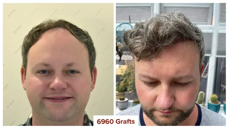Hair-Transplant-Turkey-Before-After-7000-Grafts