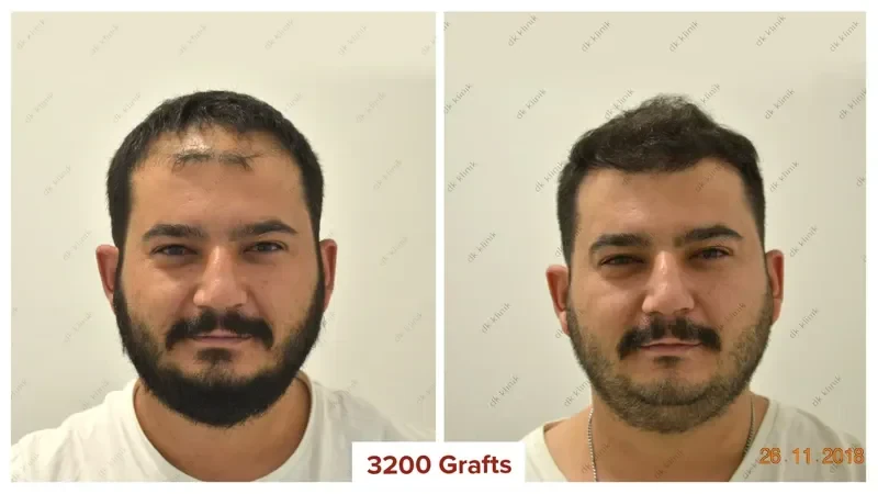 Hair-Transplant-Turkey-Before-After-3200-Grafts-5