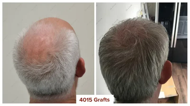 Hair-Transplant-Turkey-Before-After-4000-Grafts