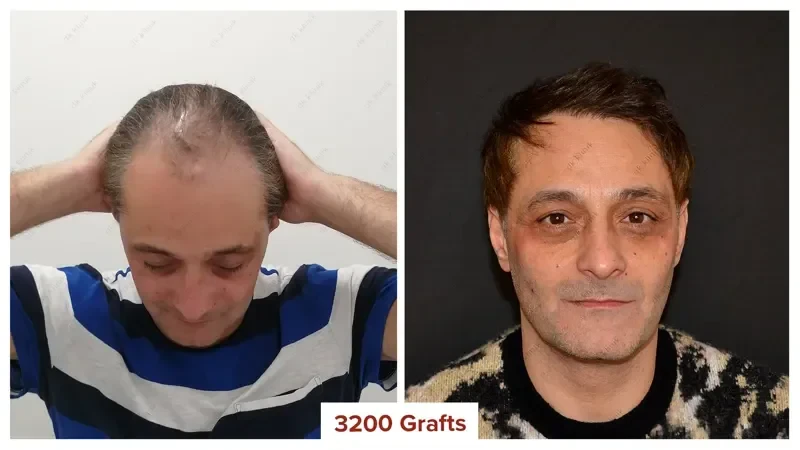 Hair-Transplant-Turkey-Before-After-3200-Grafts-3
