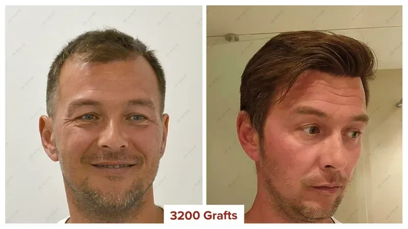 Hair-Transplant-Turkey-Before-After-3200-Grafts
