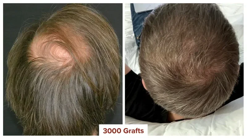 Hair-Transplant-Turkey-Before-After-3000-Grafts-2 (1)