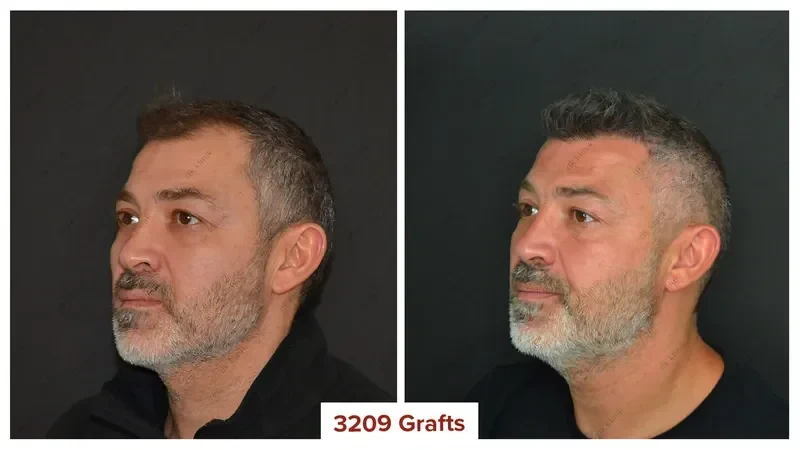 Hair-Transplant-Turkey-Before-After-3200-Grafts-2