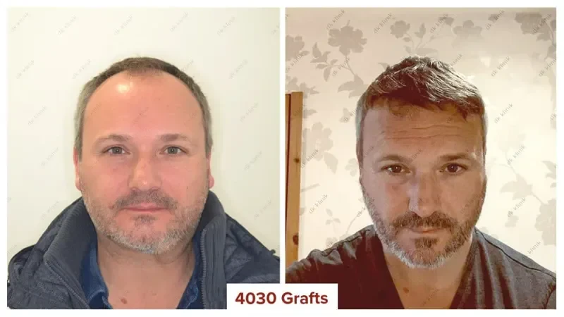 Hair-Transplant-Before-After-Turkey-4000To4500Grafts