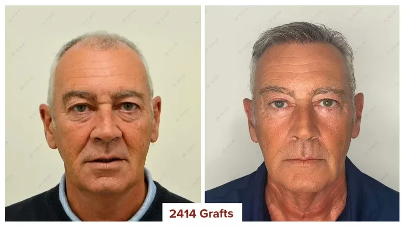 Hair-Transplant-Turkey-Before-After-2400-Grafts-2