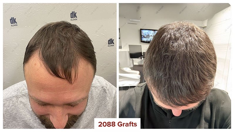 Hair-Transplant-Turkey-Before-After-2100-Graft-8