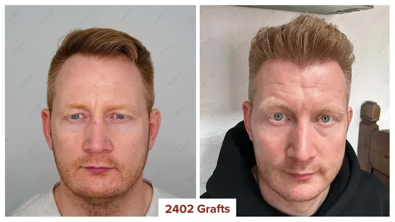 Hair-Transplant-Turkey-Before-After-2400-Grafts
