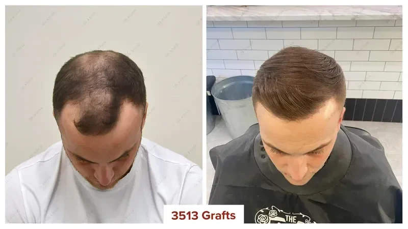 Hair-Transplant-Turkey-Before-After-3500-Grafts