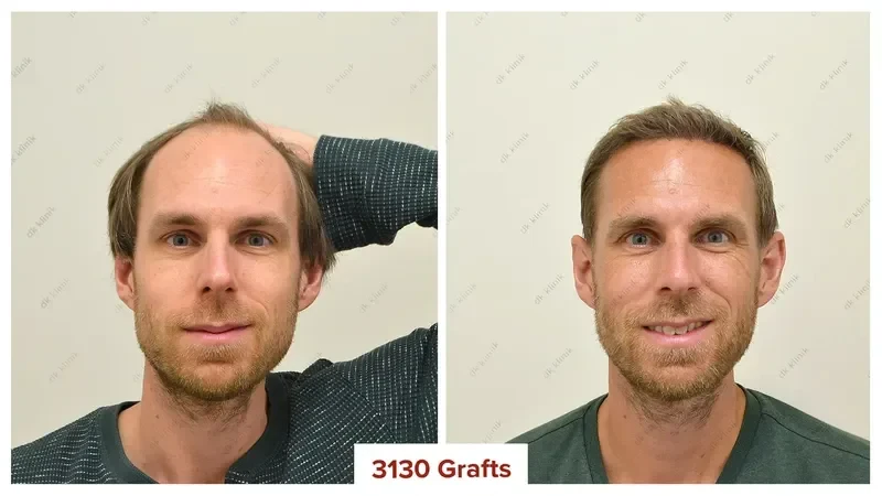 Hair-Transplant-Turkey-Before-After-3100-Grafts-2