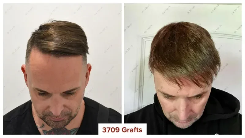 Hair-Transplant-Turkey-Before-After-3700-Grafts-2