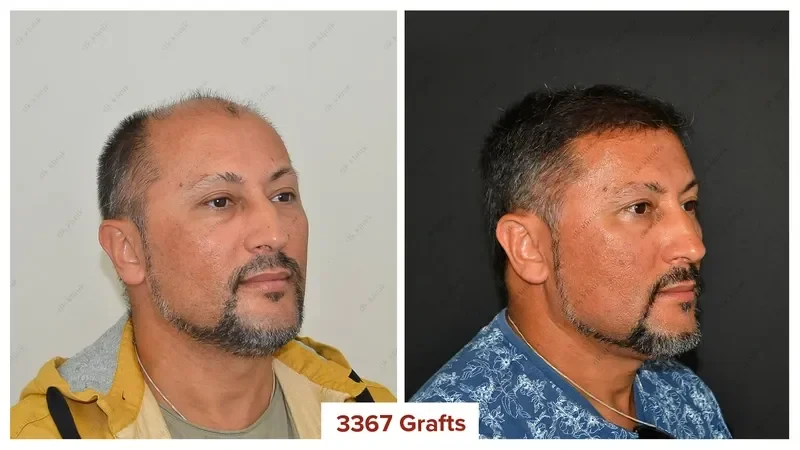 Hair-Transplant-Turkey-Before-After-3400-Grafts