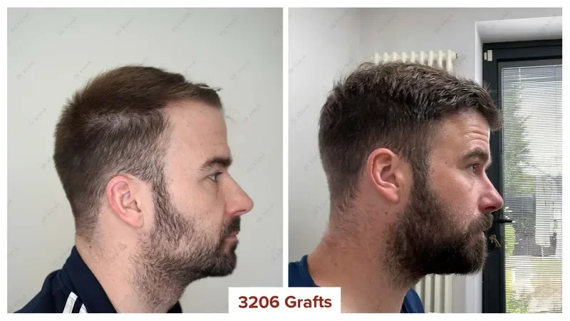 Hair-Transplant-Turkey-Before-After-3200-Grafts (1)