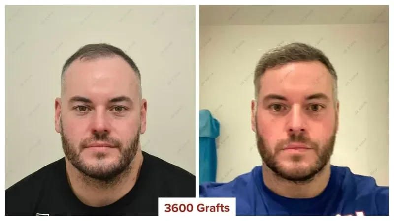 Hair-Transplant-Turkey-Before-After-3600-Grafts