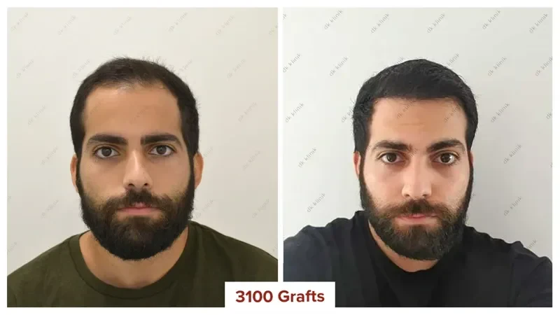 Hair-Transplant-Turkey-Before-After-3100-Grafts-3