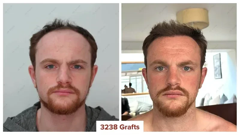 Hair-Transplant-Turkey-Before-After-3200-Grafts-7