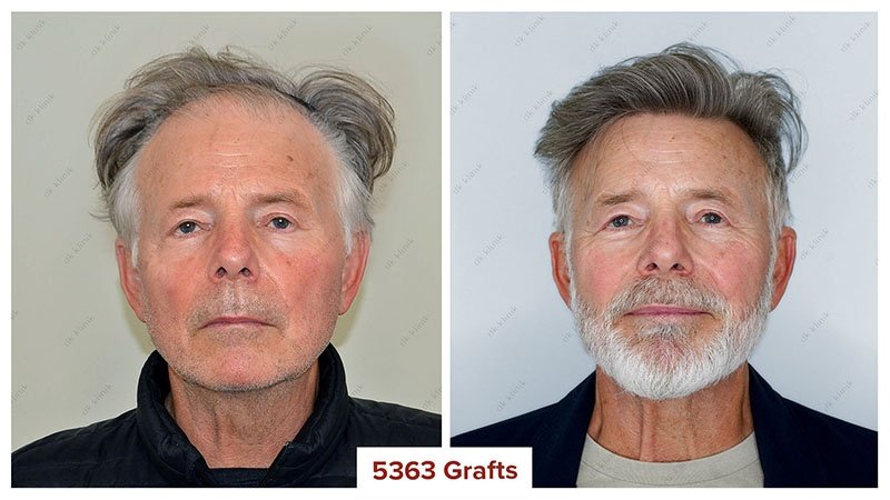 Hair-Transplant-Turkey-Before-After-5000-Graft
