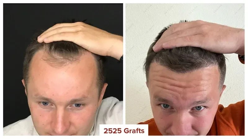 Hair-Transplant-Turkey-Before-After-2500-Grafts