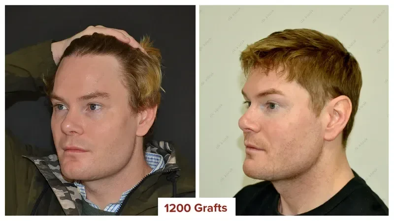 Hair-Transplant-Turkey-Before-After-1200-Grafts