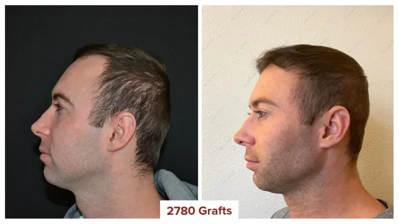 Hair-Transplant-Turkey-Before-After-2800-Grafts