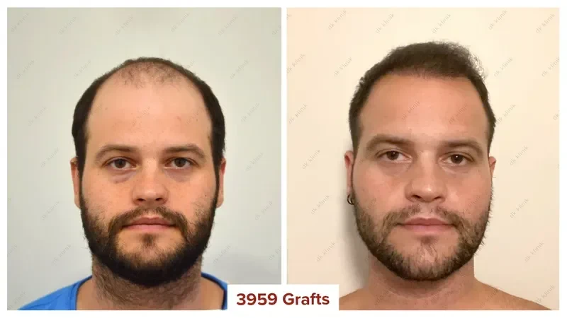 Hair-Transplant-Turkey-Before-After-4000-Grafts-2