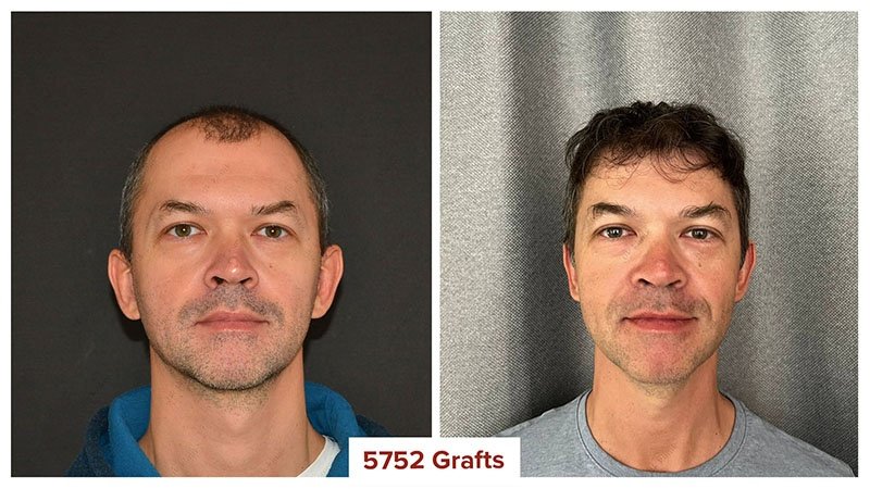 Hair-Transplant-Turkey-Before-After-5750 Graft
