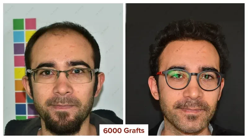 Hair-Transplant-Turkey-Before-After-6000-Grafts