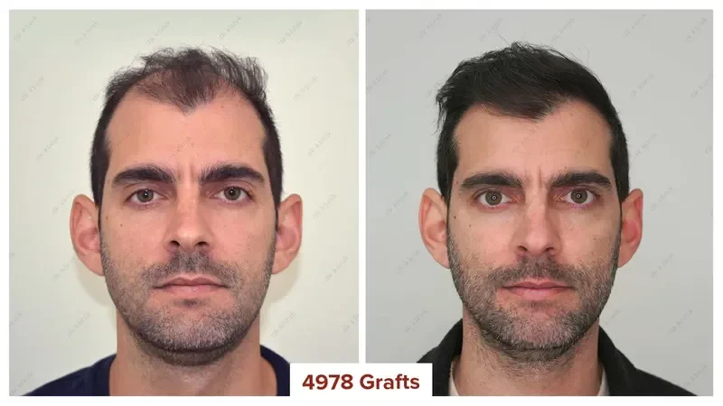 Hair-Transplant-Turkey-Before-After-5000-Grafts