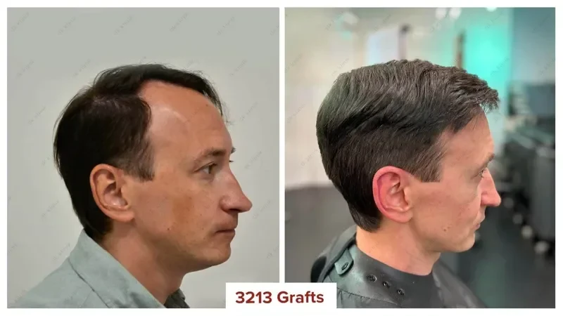 Hair-Transplant-Turkey-Before-After-3200-Grafts-8
