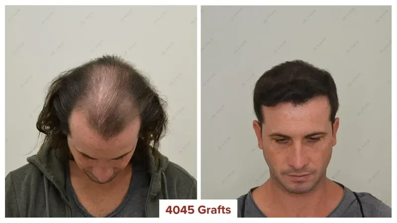 Hair-Transplant-Turkey-Before-After-4100-Grafts-2