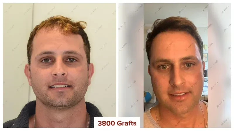 Hair-Transplant-Turkey-Before-After-3800-Grafts